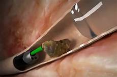 Pulses For Kidney Patients